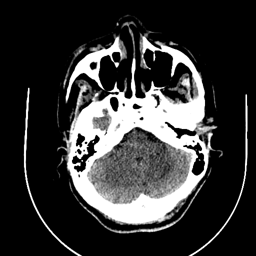 Chronic invasive fungal sinusitis (Radiopaedia 91563-109286 Axial non-contrast 16).jpg