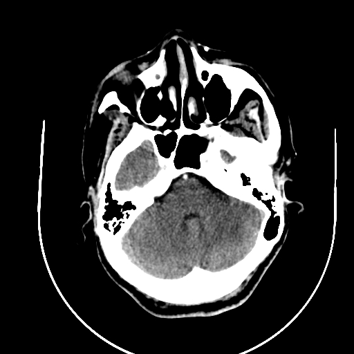 Chronic invasive fungal sinusitis (Radiopaedia 91563-109286 B 21).jpg