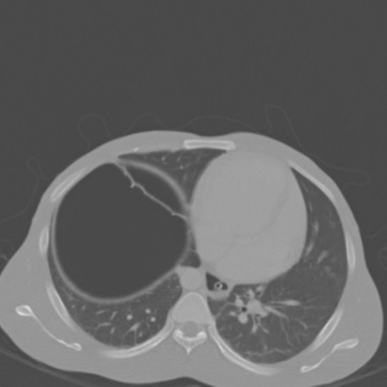 File:Chronic large bowel pseudo-obstruction (Radiopaedia 43181-46492 Axial bone window 22).jpg