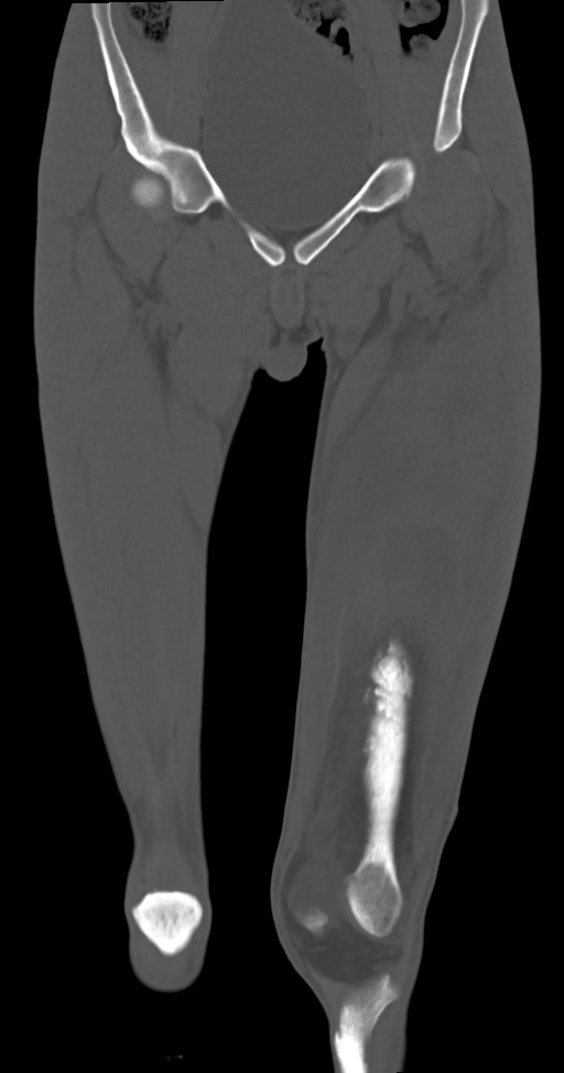 Chronic osteomyelitis (with sequestrum) (Radiopaedia 74813-85822 Coronal non-contrast 17).jpg