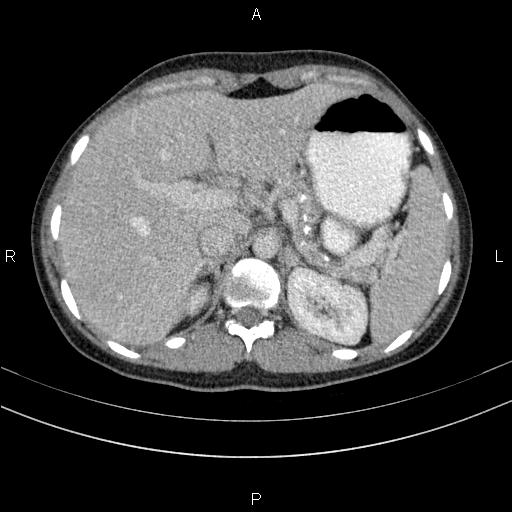 File:Chronic pancreatitis (Radiopaedia 64576-73450 C 32).jpg