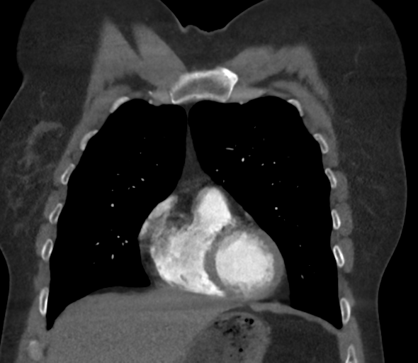 File:Chronic pulmonary embolus (Radiopaedia 39129-41341 Coronal C+ CTPA 27).png