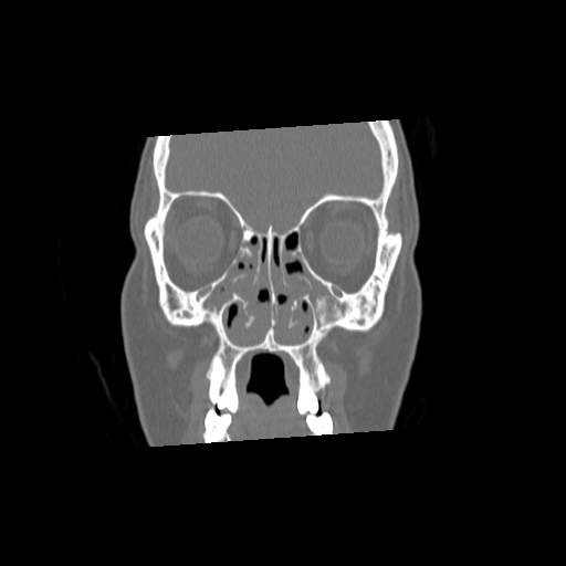 File:Chronic sinusitis with intra-sinus calcification (Radiopaedia 63919-72668 Coronal bone window 10).jpg