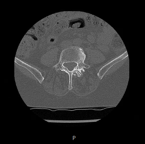 Chronic spinal hematoma with cauda equina syndrome (Radiopaedia 75745-88197 Axial bone window 56).png