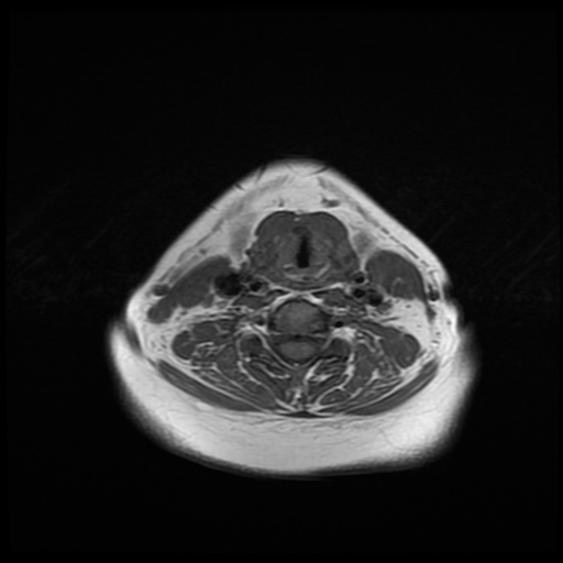 File:Chronic submandibular sialadenitis (Radiopaedia 61852-69885 Axial T1 20).jpg