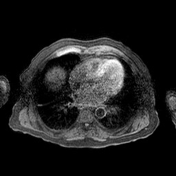 Cirrhosis and hepatocellular carcinoma in the setting of hemochromatosis (Radiopaedia 75394-86594 Axial T1 C+ fat sat 84).jpg