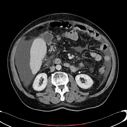 Cirrhosis and hepatocellular carcinoma in the setting of hemochromatosis (Radiopaedia 75394-86595 B 44).jpg