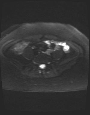 Class II Mullerian duct anomaly- unicornuate uterus with rudimentary horn and non-communicating cavity (Radiopaedia 39441-41755 Axial DWI 1).jpg