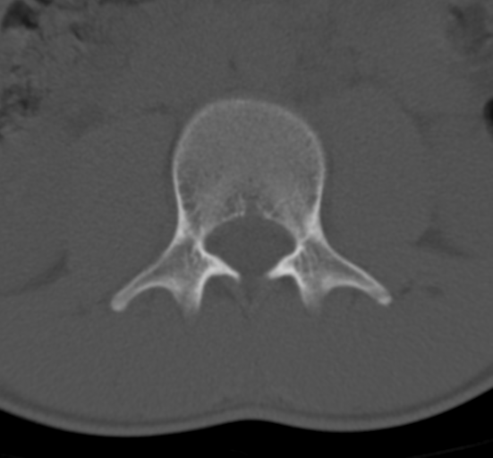 Clear cell meningoma - lumbar spine (Radiopaedia 60116-67691 Axial bone window 27).png