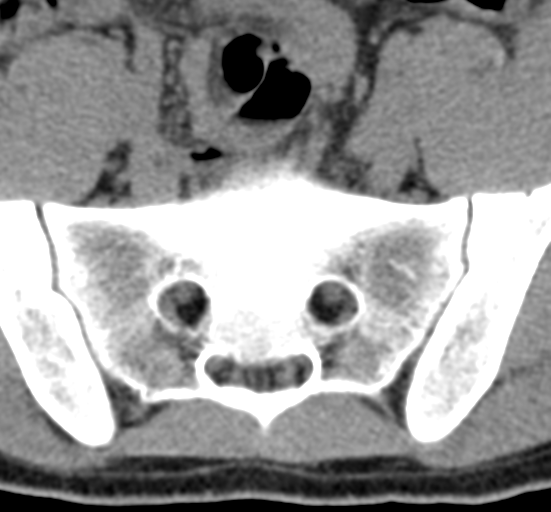 File:Clear cell meningoma - lumbar spine (Radiopaedia 60116-67691 Axial non-contrast 74).png