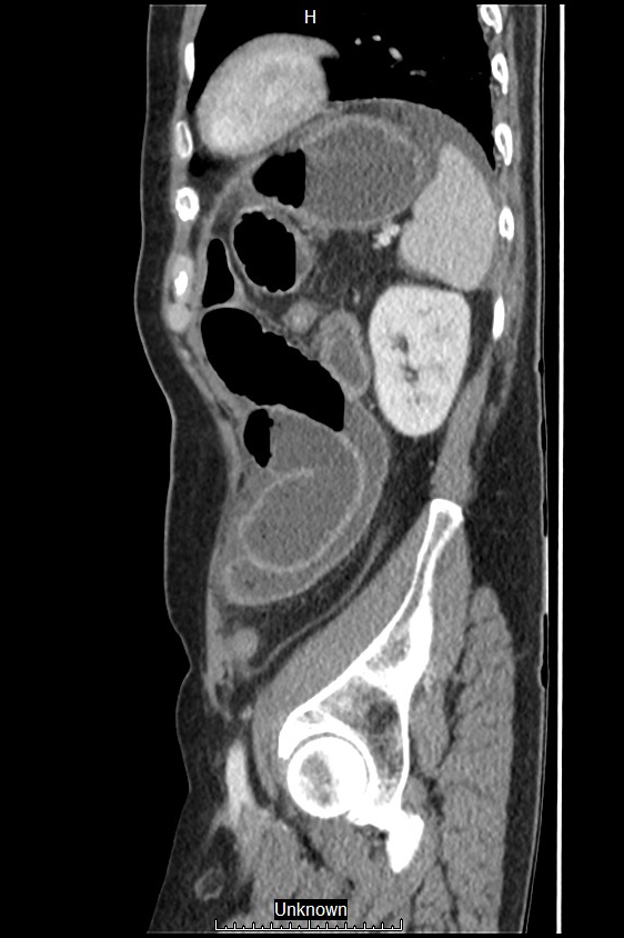 Closed loop bowel obstruction and ischemia (Radiopaedia 86959-103180 C 12).jpg