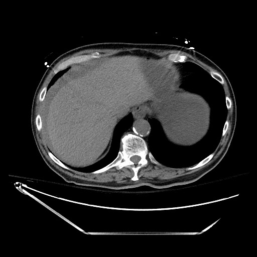 Closed loop obstruction due to adhesive band, resulting in small bowel ischemia and resection (Radiopaedia 83835-99023 Axial non-contrast 28).jpg
