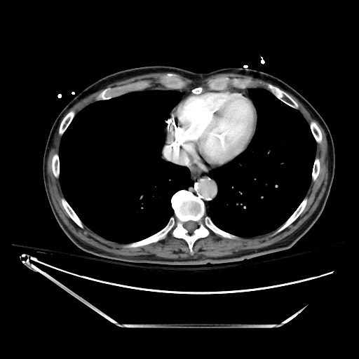 File:Closed loop obstruction due to adhesive band, resulting in small bowel ischemia and resection (Radiopaedia 83835-99023 D 15).jpg