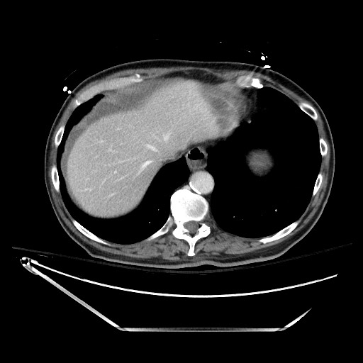 File:Closed loop obstruction due to adhesive band, resulting in small bowel ischemia and resection (Radiopaedia 83835-99023 D 26).jpg