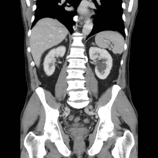 File:Closed loop small bowel obstruction (Radiopaedia 59227-66554 B 32).jpg