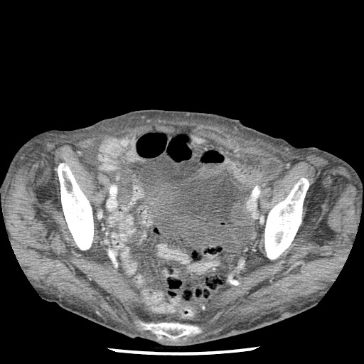 File:Closed loop small bowel obstruction - adhesions and infarct (Radiopaedia 85125-100678 B 86).jpg