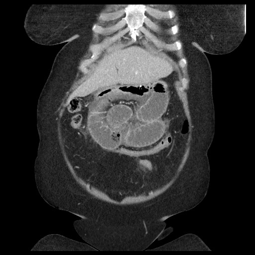 Closed loop small bowel obstruction - internal hernia (Radiopaedia 65402-74450 B 25).jpg