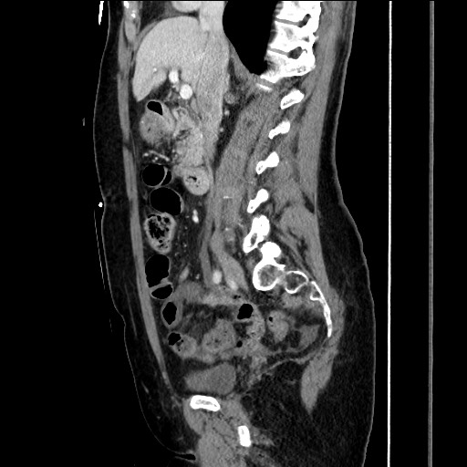 Closed loop small bowel obstruction due to adhesive bands - early and late images (Radiopaedia 83830-99014 C 81).jpg