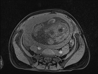 Closed loop small bowel obstruction in pregnancy (MRI) (Radiopaedia 87637-104031 F 30).jpg