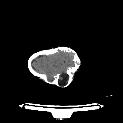 Cloverleaf skull (Radiopaedia 91901-109710 Axial non-contrast 131).jpg