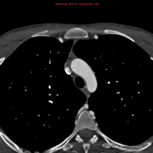 File:Coarctation of the aorta (Radiopaedia 12461-12697 A 55).jpg