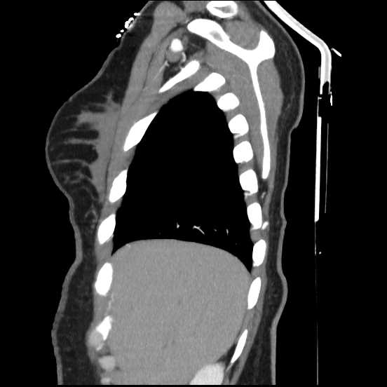 Coarctation of the aorta (Radiopaedia 67609-77010 C 56).jpg