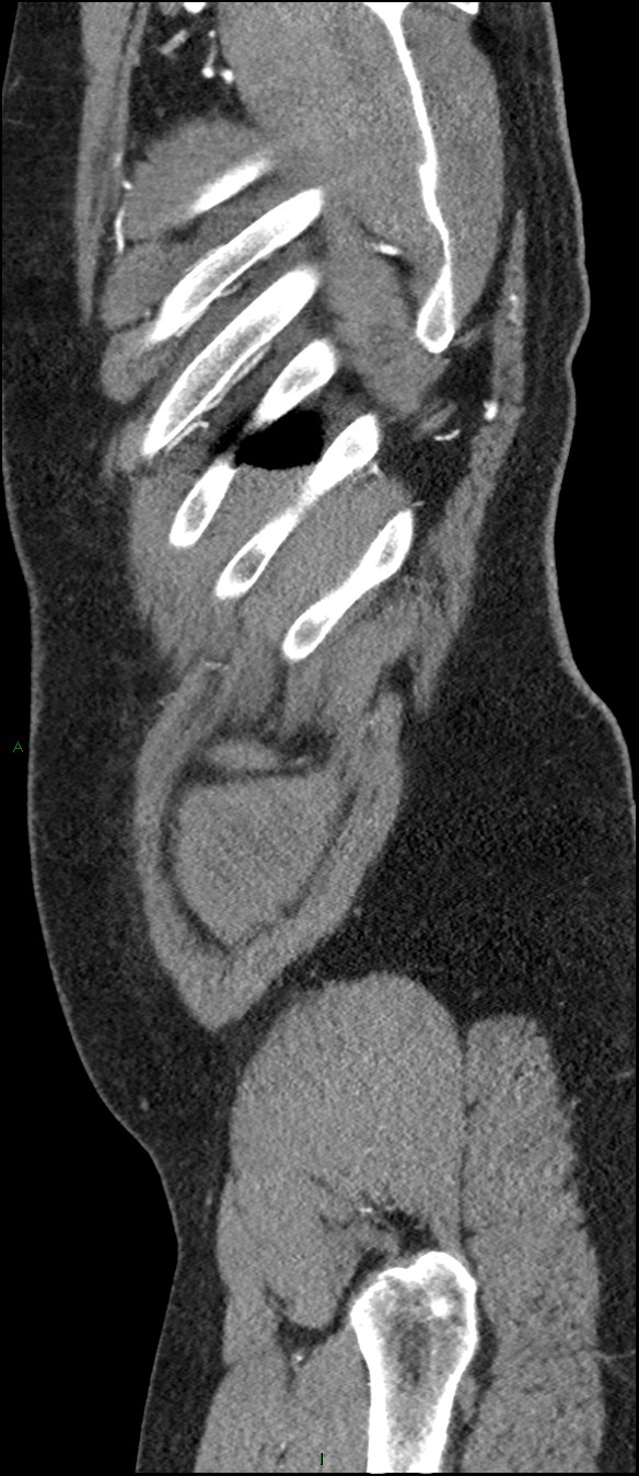 Coarctation of the aorta (Radiopaedia 74632-88521 C 308).jpg