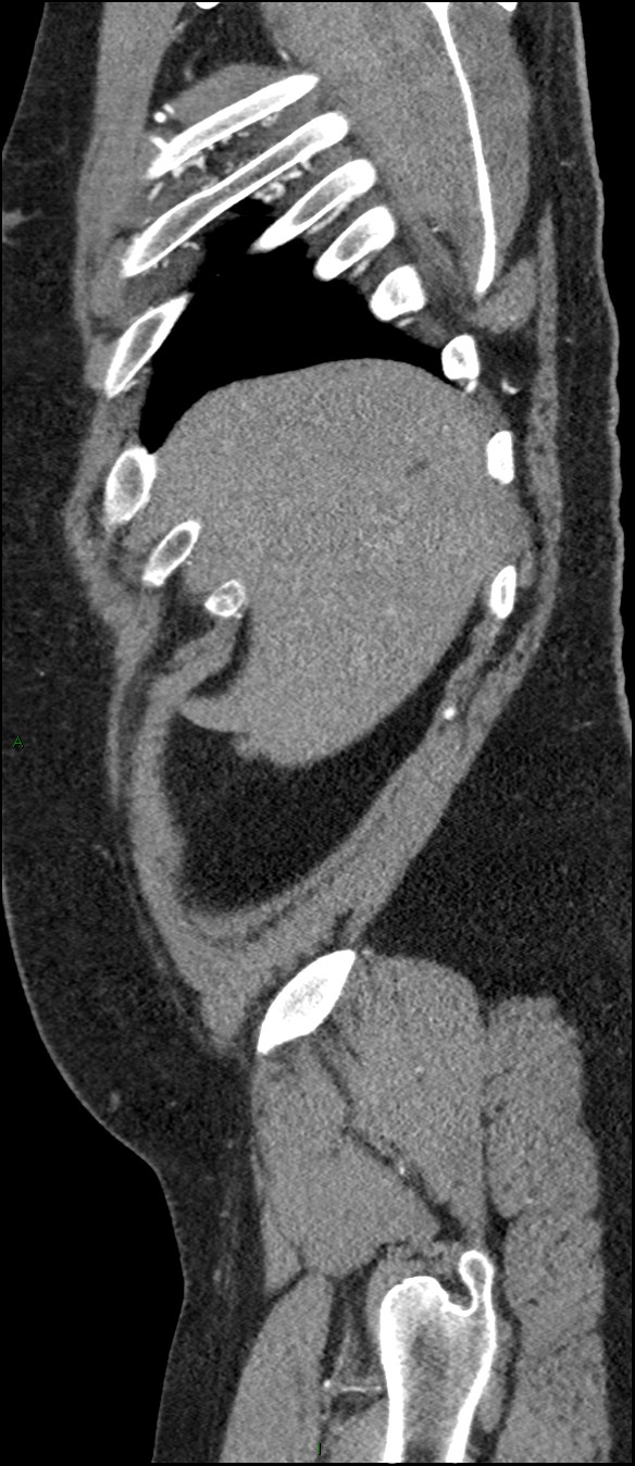 Coarctation of the aorta (Radiopaedia 74632-88521 C 31).jpg