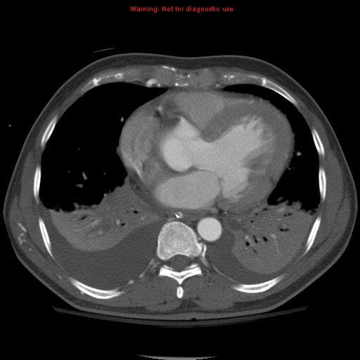 File:Coarctation of the aorta (Radiopaedia 8681-9490 B 42).jpg