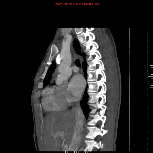 Coarctation of the aorta (Radiopaedia 9434-10118 B 23).jpg