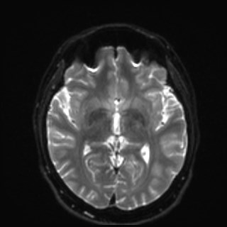 Cochlear incomplete partition type III associated with hypothalamic hamartoma (Radiopaedia 88756-105498 Axial DWI 20).jpg