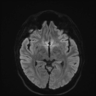 File:Cochlear incomplete partition type III associated with hypothalamic hamartoma (Radiopaedia 88756-105498 Axial DWI 59).jpg
