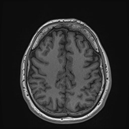 Cochlear incomplete partition type III associated with hypothalamic hamartoma (Radiopaedia 88756-105498 Axial T1 140).jpg