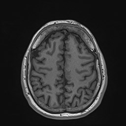 Cochlear incomplete partition type III associated with hypothalamic hamartoma (Radiopaedia 88756-105498 Axial T1 148).jpg