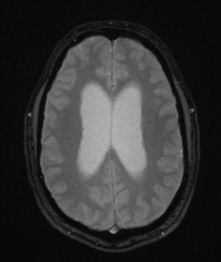 File:Colloid cyst (Radiopaedia 44510-48181 Axial Gradient Echo 18).png
