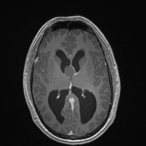 File:Colloid cyst (Radiopaedia 44510-48181 Axial T1 C+ 96).png