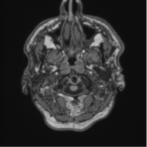File:Colloid cyst of the third ventricle (Radiopaedia 86571-102662 Axial T1 6).png