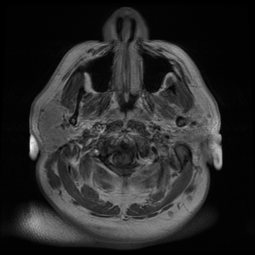 File:Colloid cyst with anterior communicating artery aneurysm (Radiopaedia 33901-35091 Axial T1 C+ 1).jpg