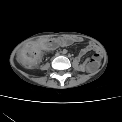 File:Colocolic fistula - Crohn disease (Radiopaedia 57063-63955 A 50).jpg