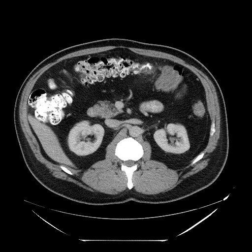 File:Colocolic intussusception due to lipoma (Radiopaedia 73712-84508 Axial 16).jpg