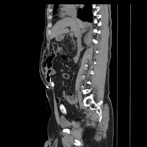 Colocutaneous fistula in Crohn's disease (Radiopaedia 29586-30093 F 8).jpg