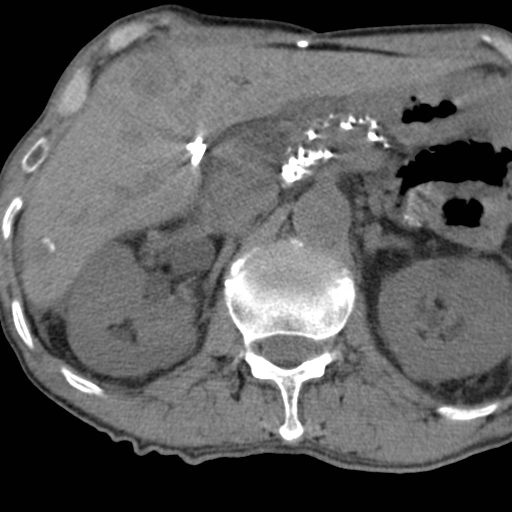 Colon cancer with calcified liver metastasis (Radiopaedia 74423-85309 Axial non-contrast 32).jpg