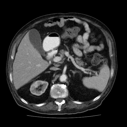 File:Colon cancer with duodenal invasion (Radiopaedia 16278-15958 A 18).jpg