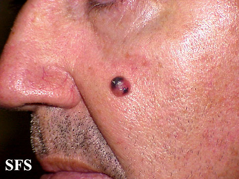 File:Melanoma (Dermatology Atlas 2).jpg