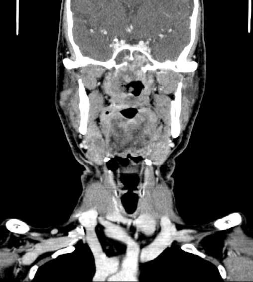 File:Nasopharyngeal carcinoma - infiltrating the clivus (Radiopaedia 62583-70875 D 18).jpg