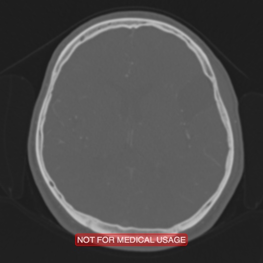Nasopharyngeal carcinoma recurrence - skull base destruction (Radiopaedia 29107-29490 Axial bone window 47).jpg