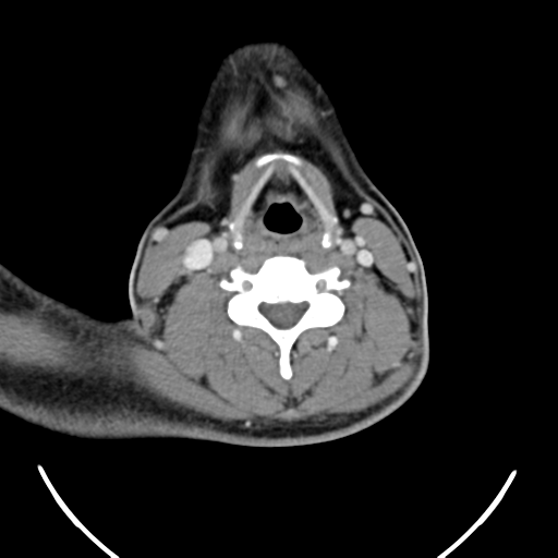 File:Nasopharyngeal carcinoma with pterygopalatine fossa involvement (Radiopaedia 33102-34132 A 39).png