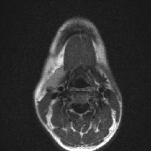 File:Nasopharyngeal carcinoma with pterygopalatine fossa involvement (Radiopaedia 33102-34134 Axial T2 1).png
