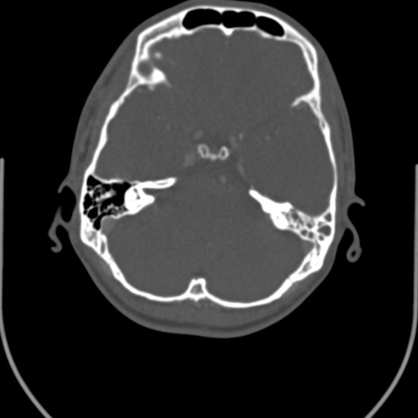 Nasopharyngeal carcinoma with skull base invasion (Radiopaedia 53415-59705 Axial bone window 2).jpg