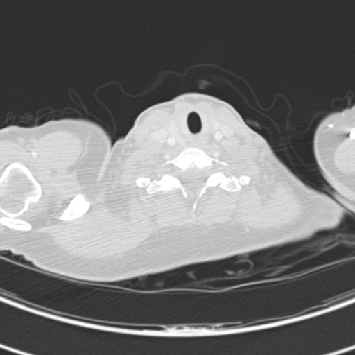 Necrobiotic pulmonary nodules - Crohn disease (Radiopaedia 20723-20631 Axial lung window 3).jpg